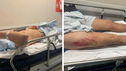 Supplied Composite image. One half of the picture is a shot of a young man lying in hospital bed. The other half is a closer-up picture of his leg, with significant grazes and bruising.