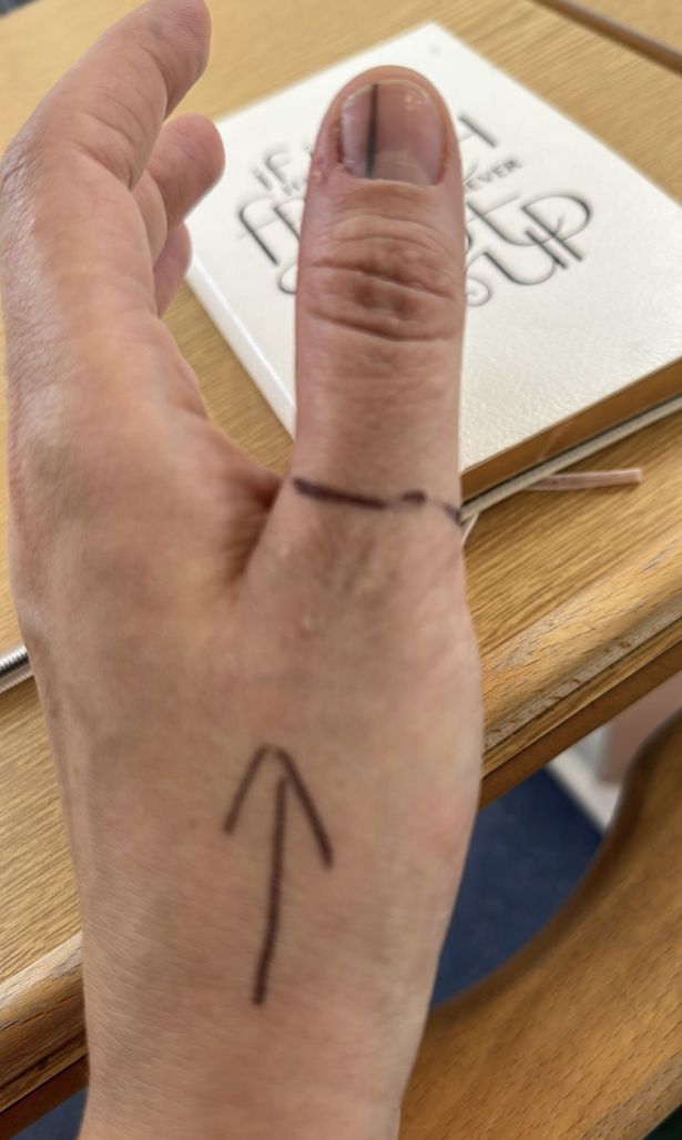 Lucy became worried after spotting the mark on her thumb