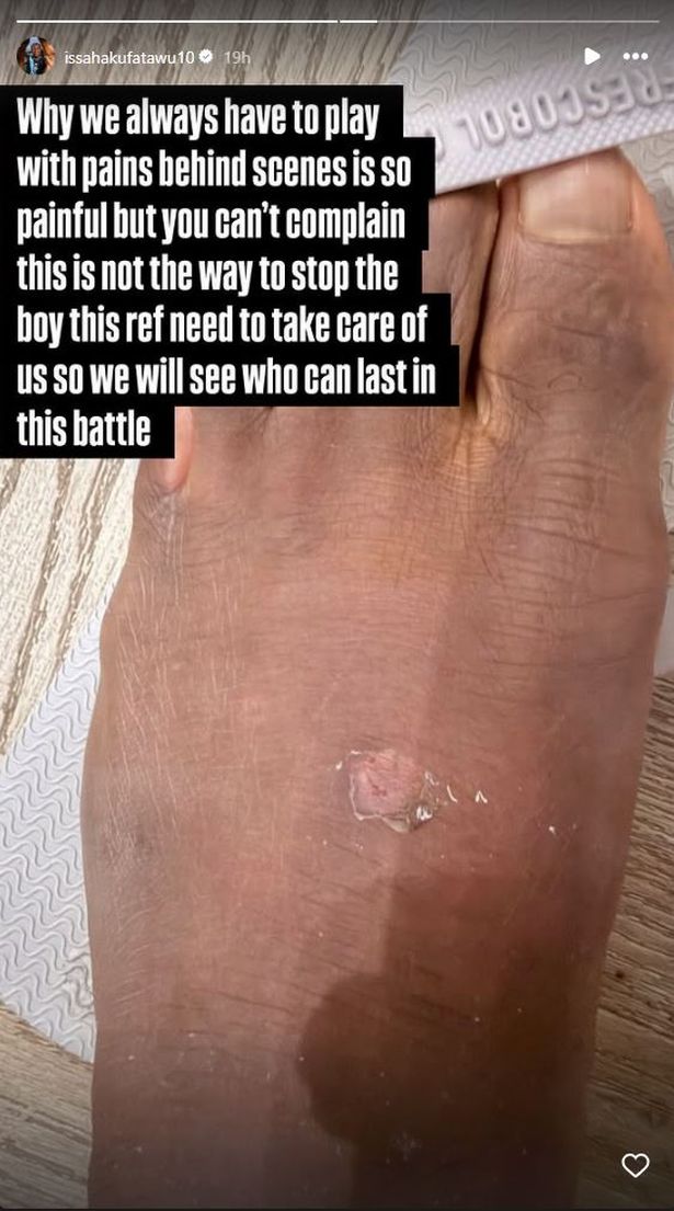 A picture of Abdul Fataawu's left foot