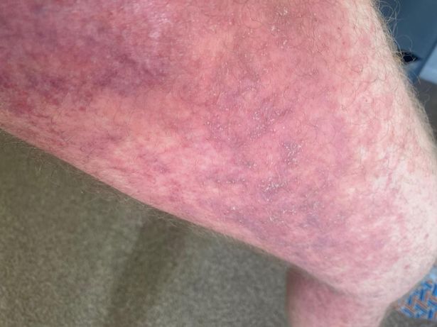 Callum's limbs went 'a weird purple'