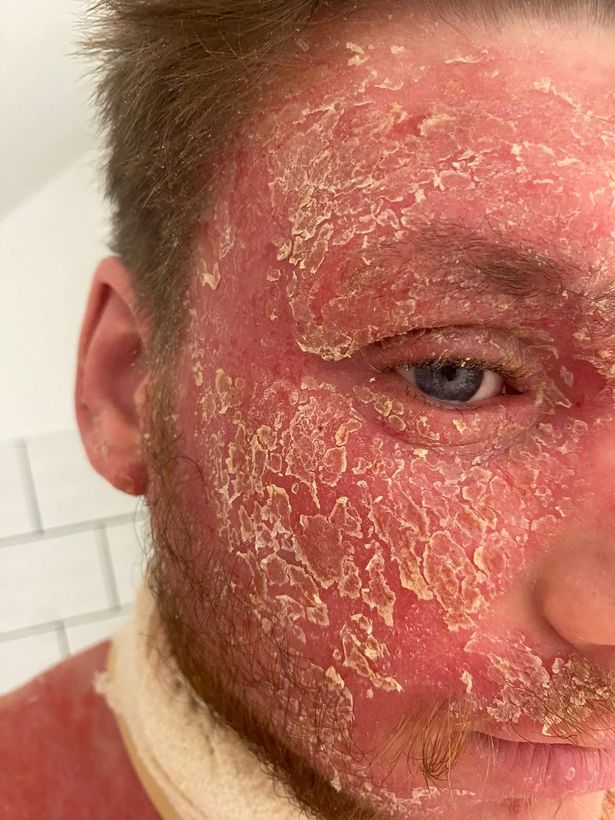 TSW causing a severe reaction to Callum Hobson's skin