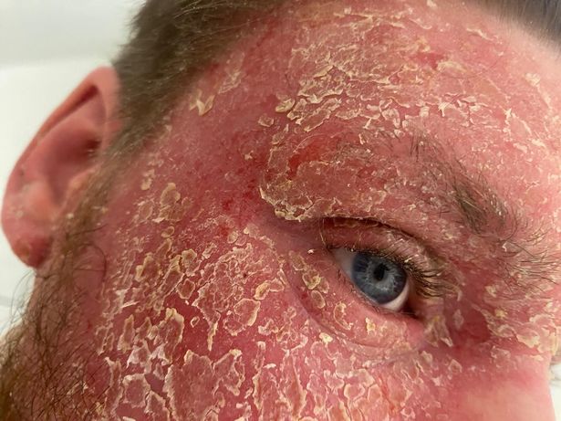 East Hull dad Callum Hobson wants to raise awareness around the skin condition TSW, or Topical Steroid Withdrawal