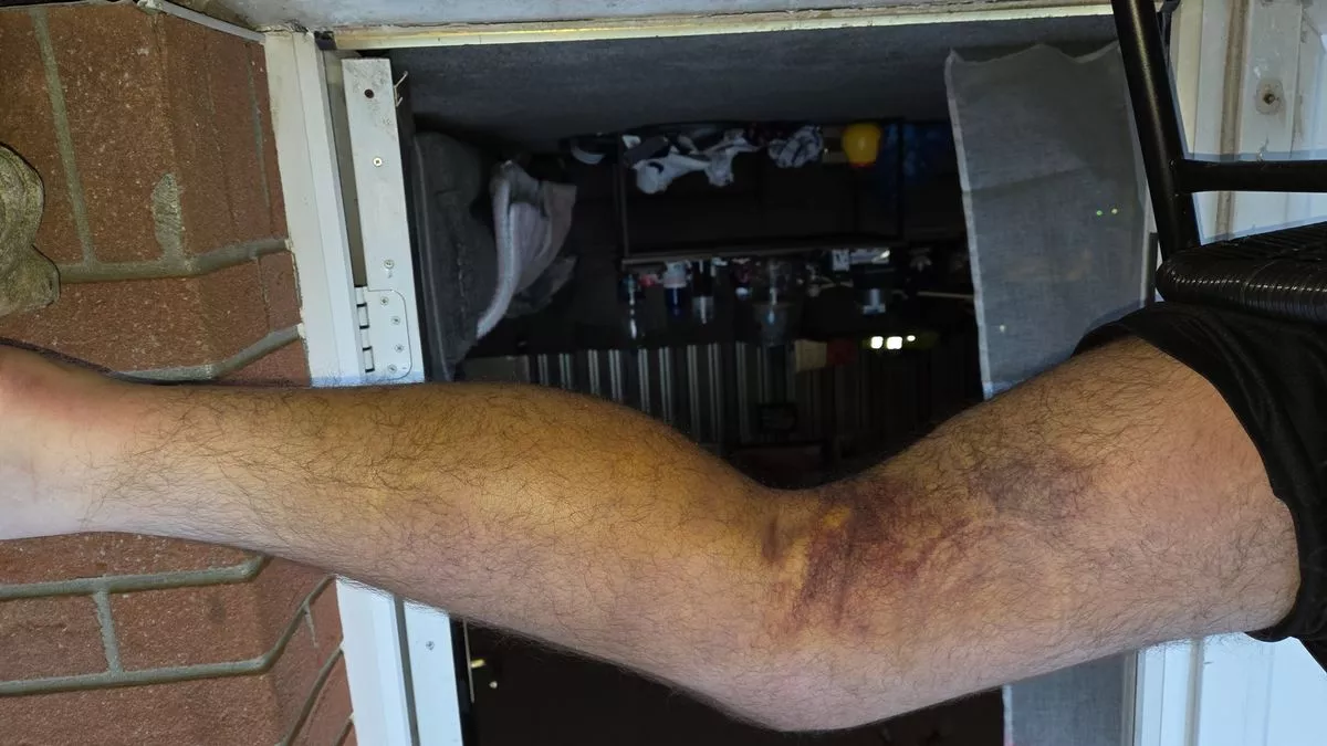 The 'massive haematoma clot' in Alex's left leg