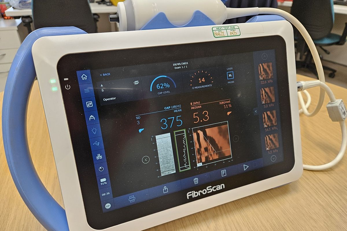 The fibroscan machine uses ultrasound technology to check for signs of liver stiffness