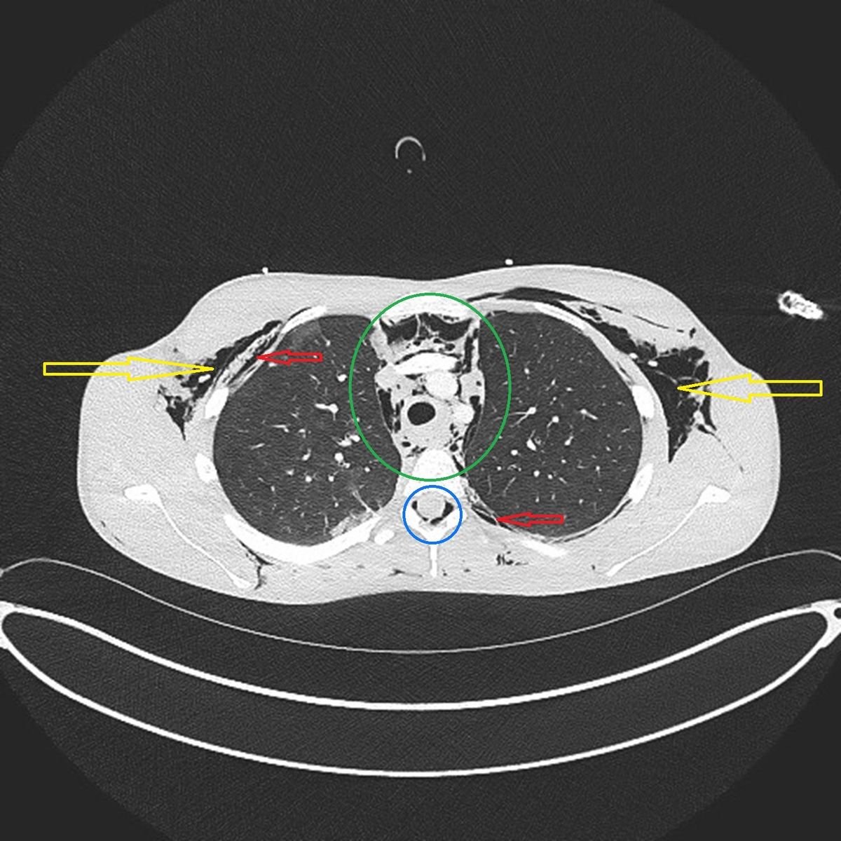 A CT scan identified pockets of air around the spinal canal
