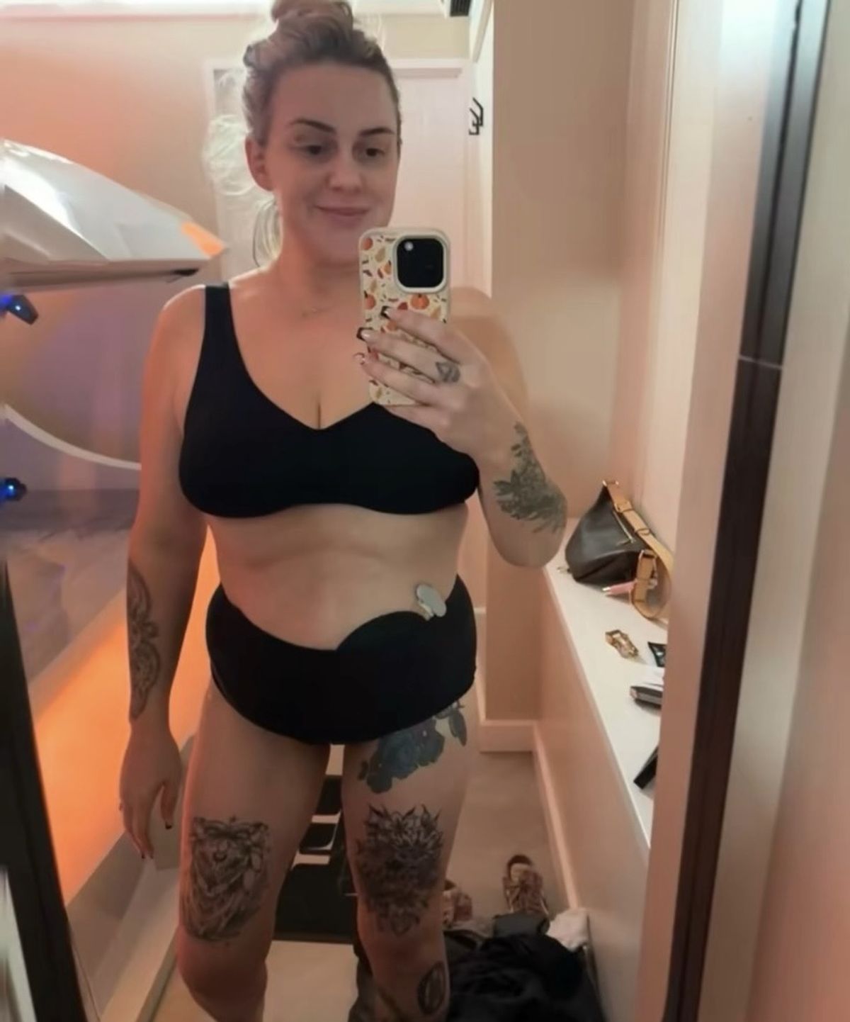 Jenna Robinson showing her colostomy bag