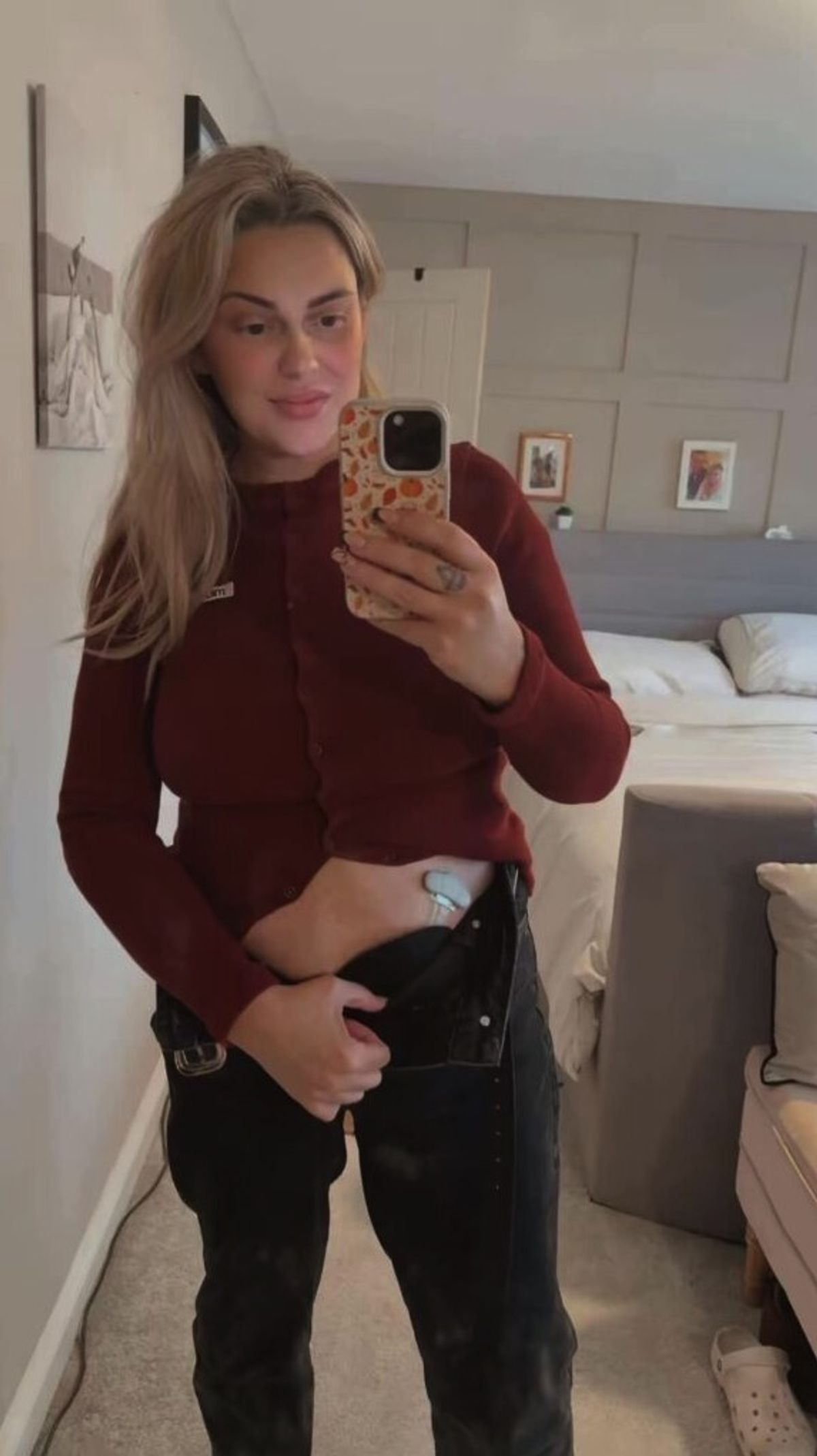 Jenna Robinson showing her colostomy bag