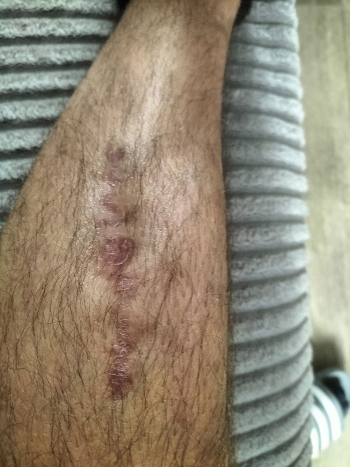 The Hull man has been left with a scar following the incident in June 2024