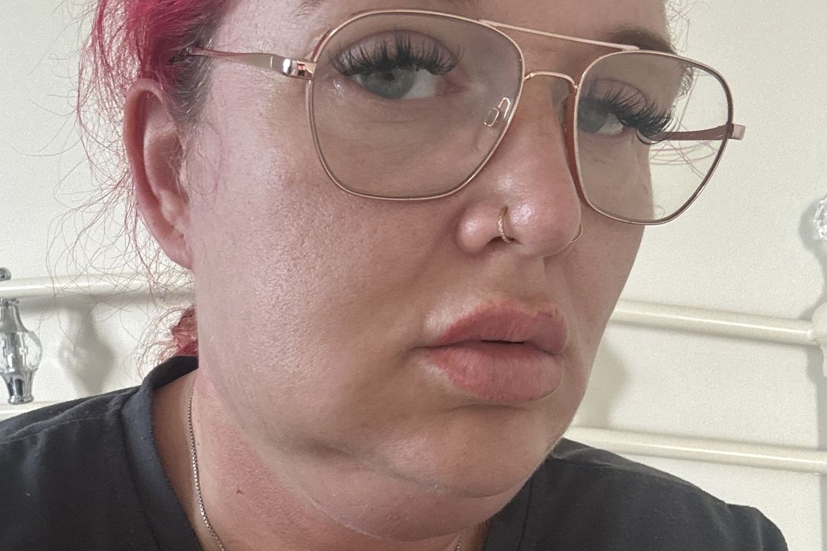 Antonia Glover was left with swelling and scarring (Kennedy News and Media)
